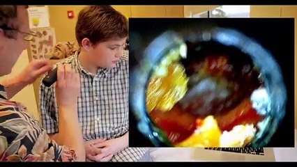 PAINFUL EAR INFECTION - EAR WAX REMOVAL - Dr Paul 2017