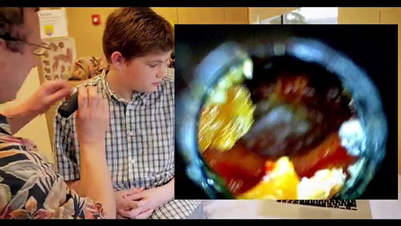 PAINFUL EAR INFECTION - EAR WAX REMOVAL - Dr Paul 2017