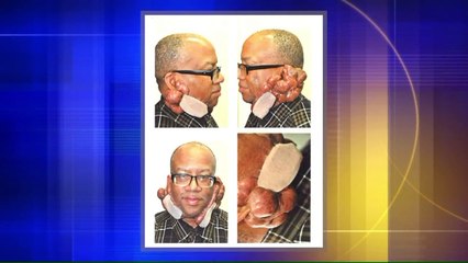 Generosity of Strangers Helps Man Get Debilitating Keloids Removed After Insurance Denial