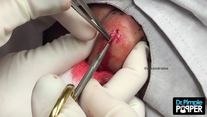 A Big Cyst SQUEEZE on the cheek: From reddit popping!