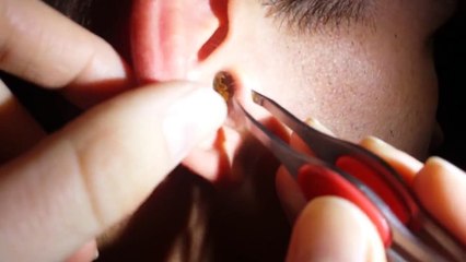 Il Se Fait Retirer Un Bouchon De Cerumen De L Oreille Video Dailymotion