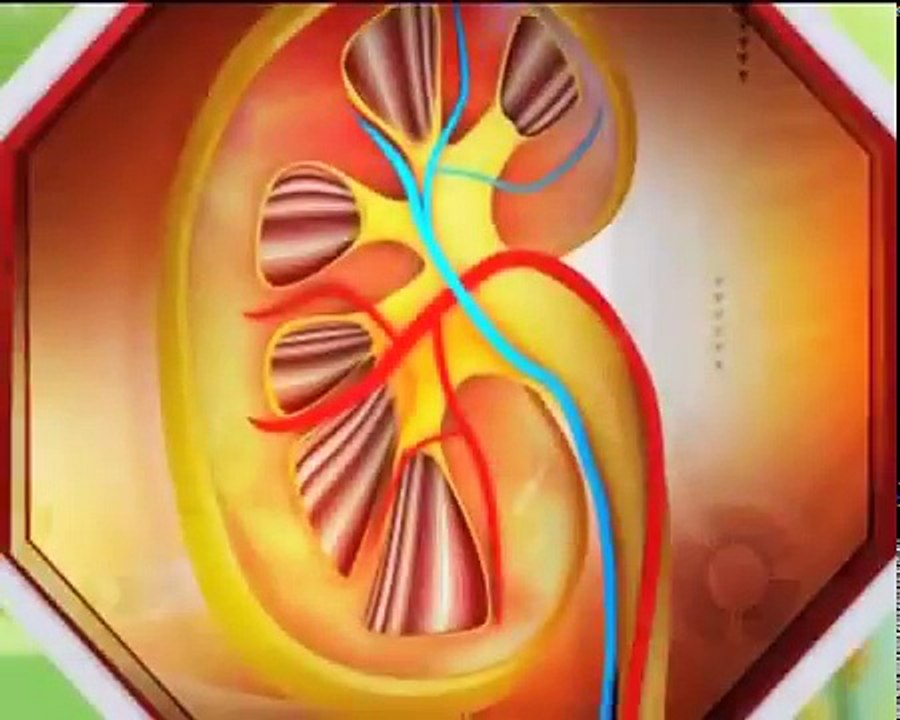 Chronic Kidney Disease Treatment  CKD (From Stage 1 - End stage) _ Stop Kidney Dialysis