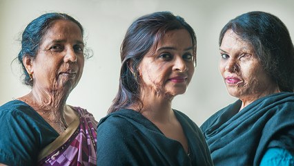 Make Love Not Scars: Acid Attack Survivors Get A Second Chance