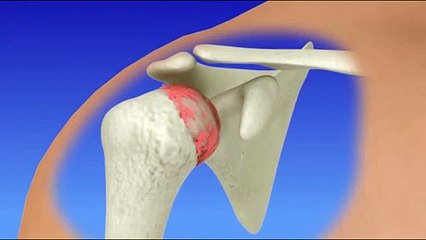 Symtomps and Treatment for Shoulder Replacement Surgery - Surgivisor