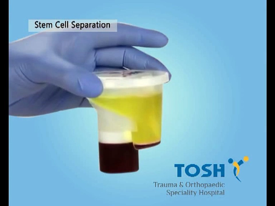 Say "NO" to Total Knee Replacement.  An Alternate Treatment for Knee Arthritis, Tosh Hospitals, Chennai.