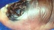 Skin Cancer Types in NYC | Pictures of Skin Cancer Symptoms by Dr. Ron Shelton