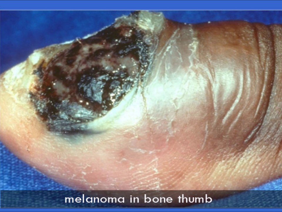 Skin Cancer Types in NYC | Pictures of Skin Cancer Symptoms by Dr. Ron Shelton