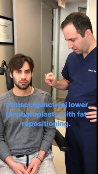 Blepharoplasty(Eyelid Lift Surgery) - Dr. Taban MD