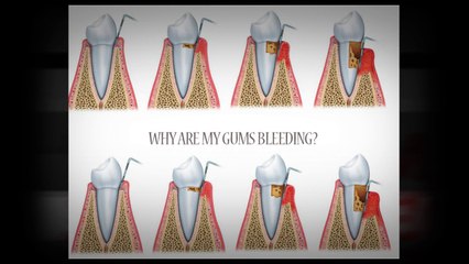 Why Are My Gums Bleeding?
