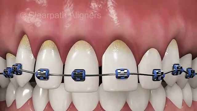 BRACES VS Clear Aligners video