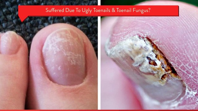 Laser Treatment for Toenail Fungus in Lake Charles