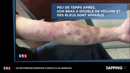 Les mystérieuses et inquiétantes morsures d'insecte d'un Américain (vidéo)