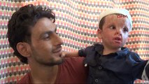 Hatay Suriyeli Baba, Yanan Oğlu Bara'ya Estetik Ameliyat Istiyor