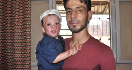 Suriyeli Baba, Yanan Oğlunu Estetik Ameliyat Yaptırmak İstiyor