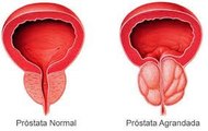 Remedios caseros para la próstata inflamada, (METODO: Rápido, muy fácil, y gratis), Pruébalo.