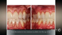 Best or Long Lasting Gum Recession Treatment
