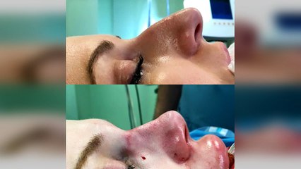 Spitali Amerikan-Nderhyrjet plastike