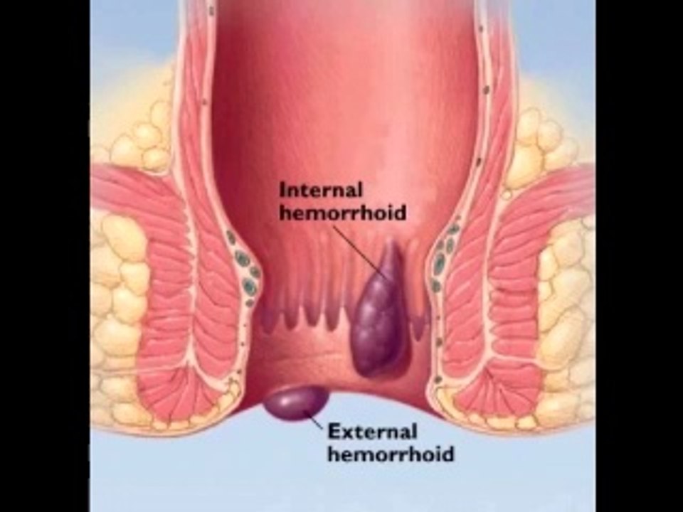 Hemorroides