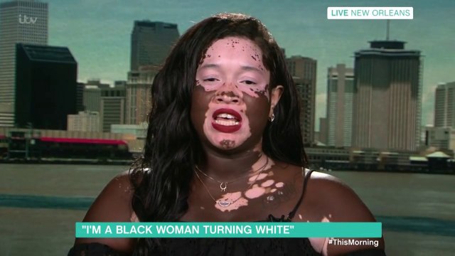 Cette femme noire devient blanche à cause d'une maladie de peau !
