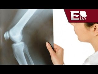 México desarrolla nuevo tratamiento para erradicar el cáncer de hueso/ Titulares de la tarde