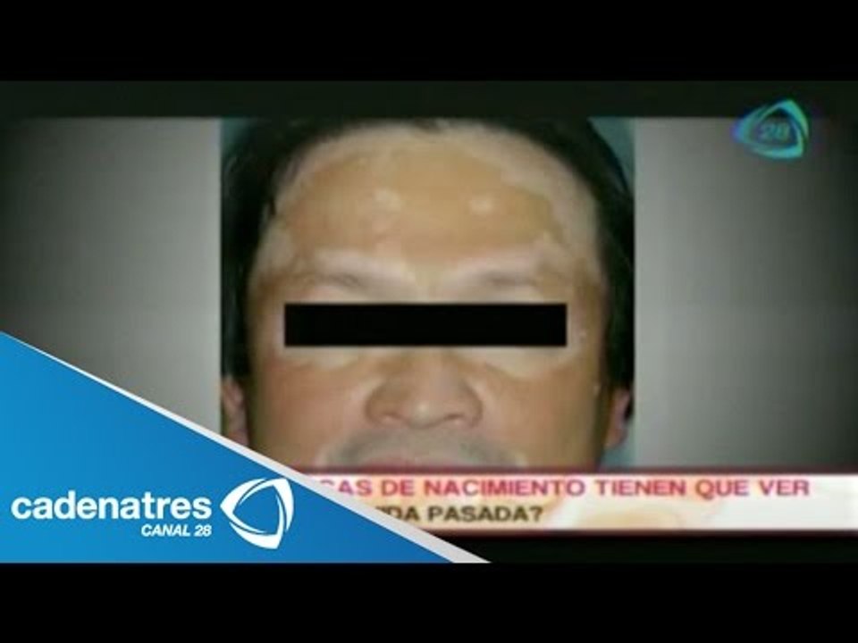 ¿Las marcas del nacimiento hablan de nuestra vida pasada?