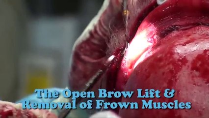Get a Glimpse Plastic Surgery Video in 60 secs. Live demos on Eyelift, Facelift, Browlift, Liplift,