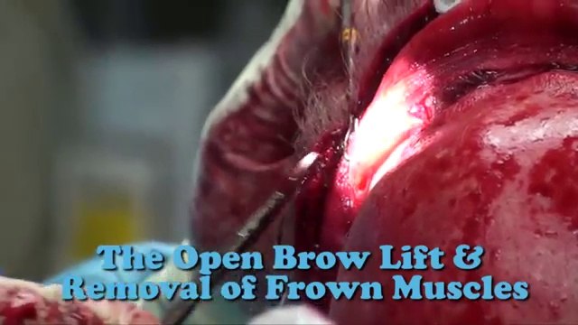 Get a Glimpse Plastic Surgery Video in 60 secs. Live demos on Eyelift, Facelift, Browlift, Liplift,