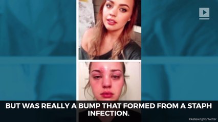 Pimple-popping horror story goes viral