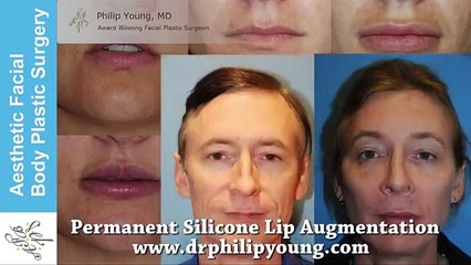 Warning Graphic: Permanent Silicone Lip Augmentation Live Video Demo