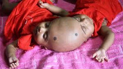 Surgery Hope For Conjoined Twins- BORN DIFFERENT