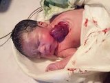 Baby Born With Heart Outside Her Chest