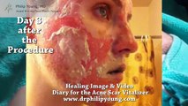 Acne Scar Laser Healing Diary: Video with Images, Live Demo Cleaning after the Acne Scar Vitalizer
