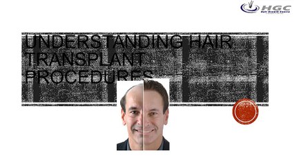 Understanding Hair Transplant Procedures