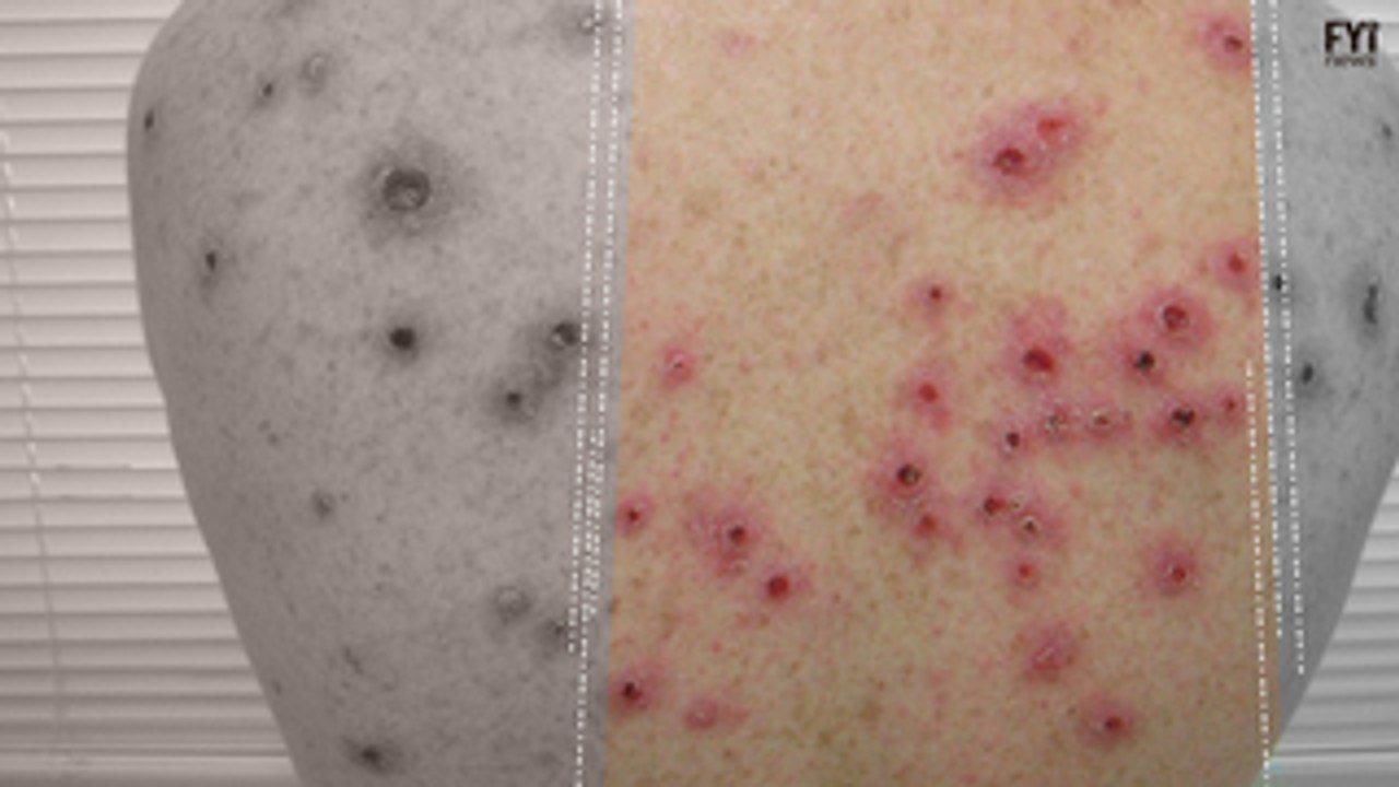 Syphilis Outbreak In Brazil
