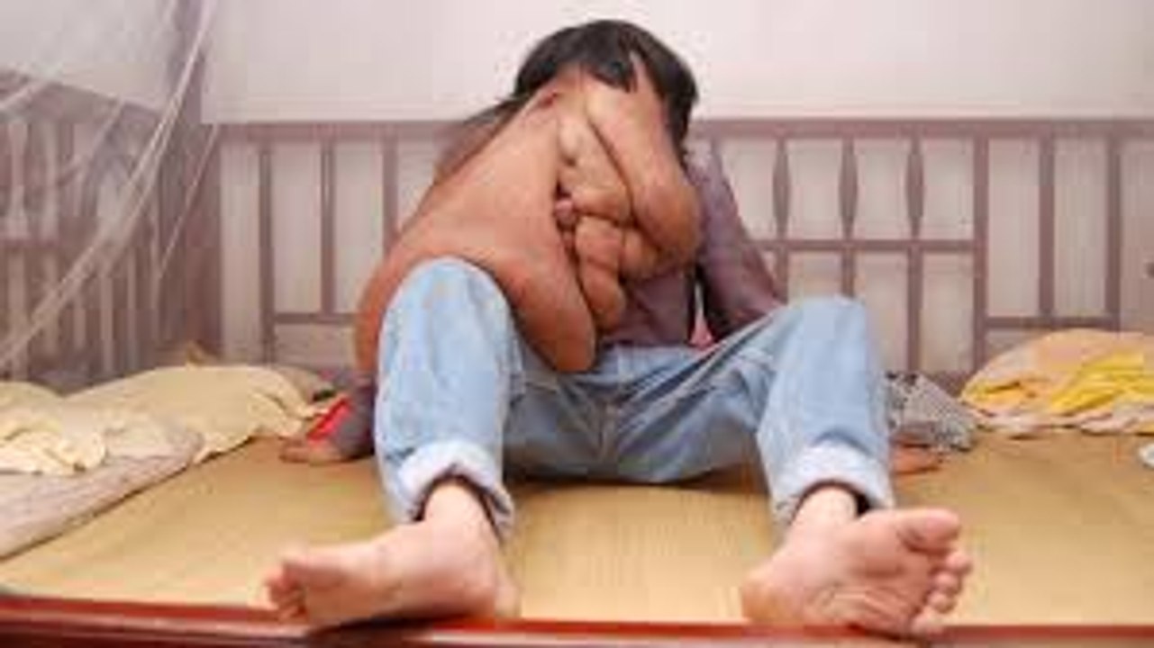 China's Elephant Man - My Face Melted- Body Bizarre Episode 7