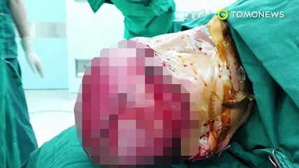 공장 여직원, 기계에 머리카락 끼여, 머리가죽이 훌러덩 벗겨져, 기적적으로 생존