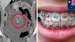 Dental wire from braces lodged in woman's intestine for  10 years