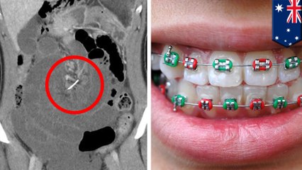 Dental wire from braces lodged in woman's intestine for  10 years