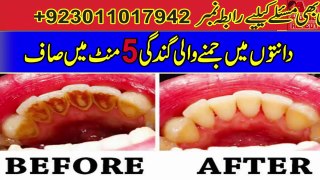 Dental Plaque Homemade Treatment In Just 5 Minutes | Teeth Whitening Tips In Urdu/Hindi