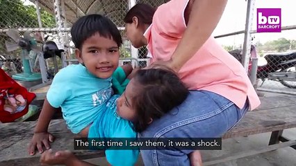 Together Forever- Conjoined Twins Don’t Want To Be Separated