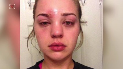 Woman's Terrifying Story Will Have You Thinking Twice Before You Pop a Pimple
