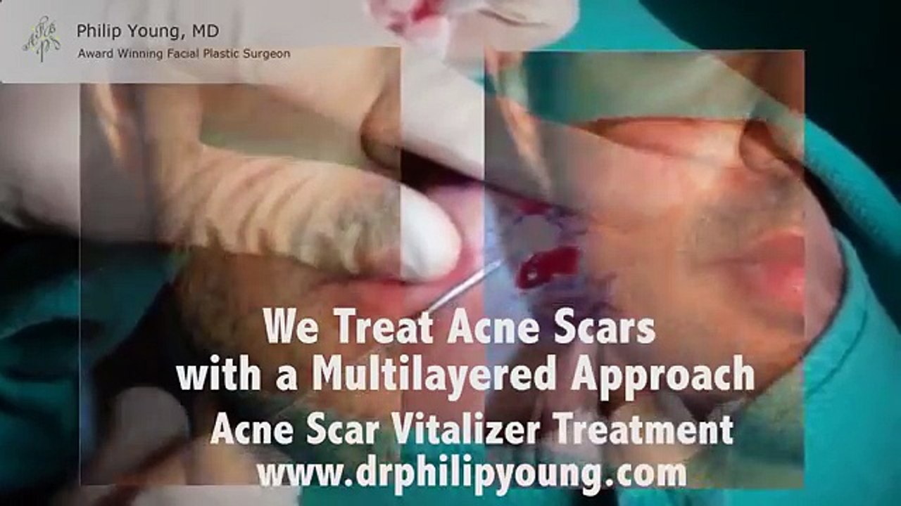 Treat All Types of Acne Scars in One Treatment in 2 Hours with the New Acne Scar Vitalizer Treatment