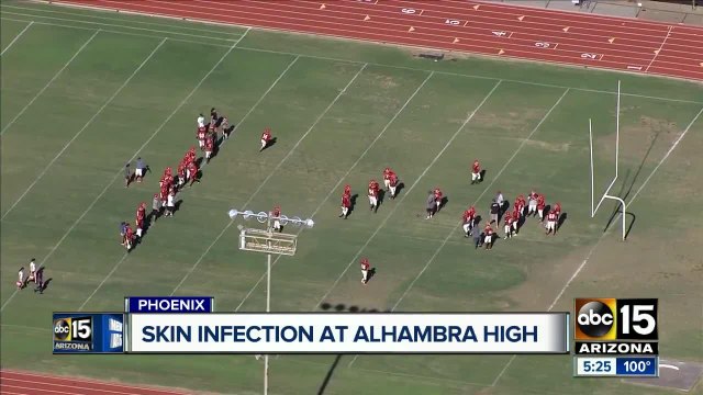 High school football game canceled due to skin infection