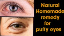 How to get rid puffy eyes ,swollen eyelids & dark
