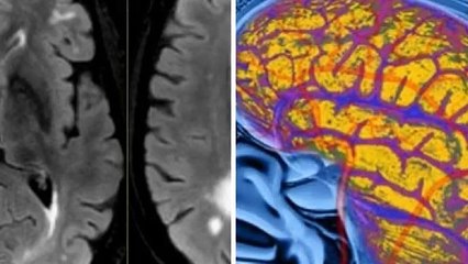 Cerebral x this implies people will have the capacity to take in, process, and hold data considerably more rapidly