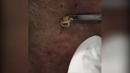Những màn nặn mụn kinh điển