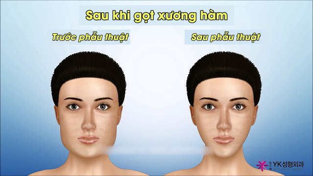 Đã bao giờ bạn tự hỏi rằng các bác sĩ phẫu thuật thẩm mỹ tạo ra gương mặt V line như thế nào chưa?