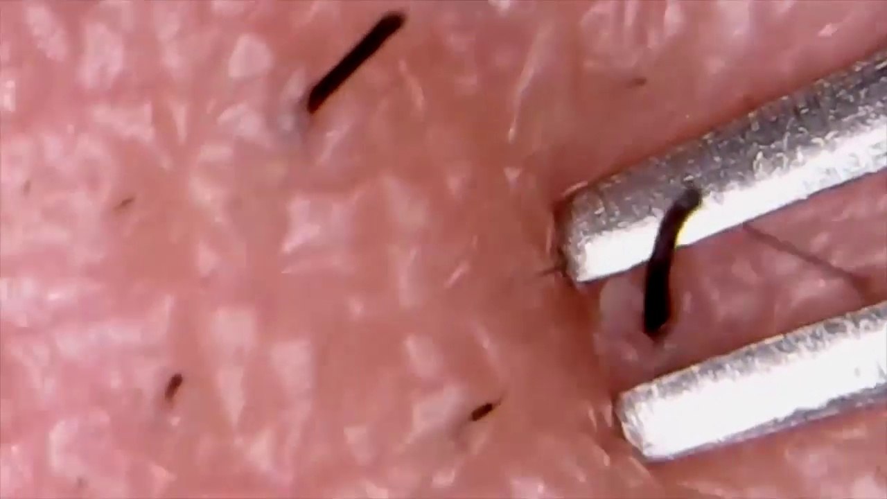 Tín đồ nặn mụn lại lên cơn sốt với clip nặn mụn cận cảnh mới nhất năm 2017