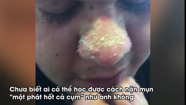 Pha nặn mụn cực phẩm đã mắt chưa từng có trên trái đất