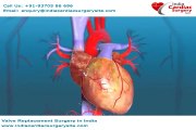 Valve Replacement Surgery in Mumbai - the best affordable package for your cardiac treatment in India